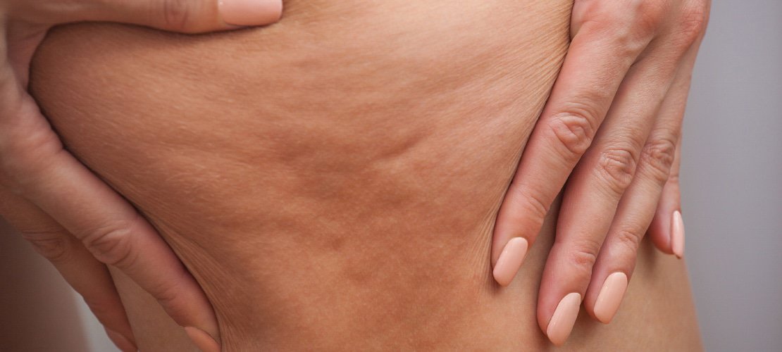 Cellulite: de fabels en feiten