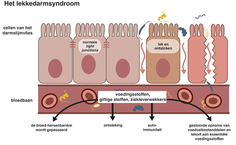 Lekkedarmsyndroom